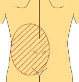 急性膵炎の症状（背部側）