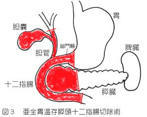 亜全胃温存膵頭十二指腸切除術
